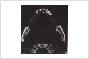 インプラント治療の例