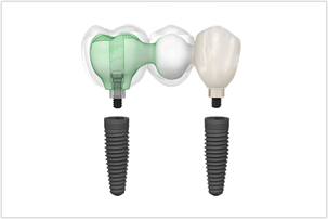インプラント治療の例